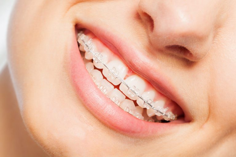 clear ceramic braces
