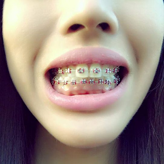 braces Lawrenceville